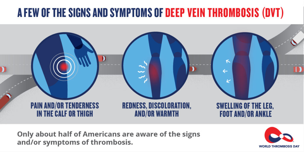 Deep Vein Thrombosis (DVT) Doctor Cahn